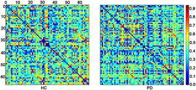 Abnormalities in Structural Covariance of Cortical Gyrification in Parkinson's Disease